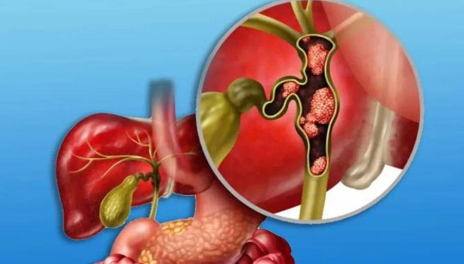 文献解读|Cell Rep Med（14.3）：胆道癌患者来源类器官的个性化药物