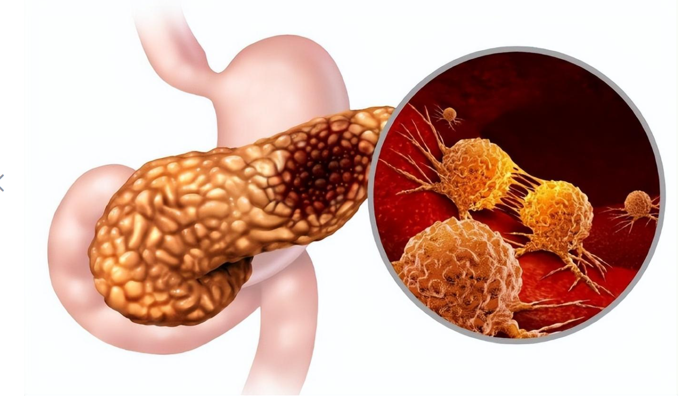 文献解读|Nat Commun（16.6）：抑制基质 I 类 HDAC 可抑制胰