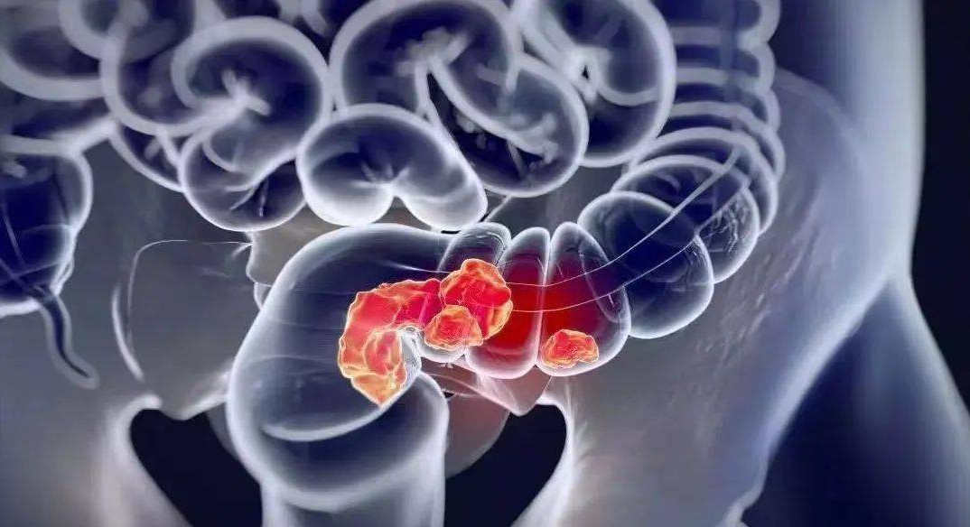 文献解读|Cell Rep Med（14.3）：结直肠癌对放化疗和靶向治疗反应的