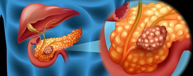 文献解读|Cell Rep Med（14.3）：针对胰腺癌新辅助化疗诱导的代谢重
