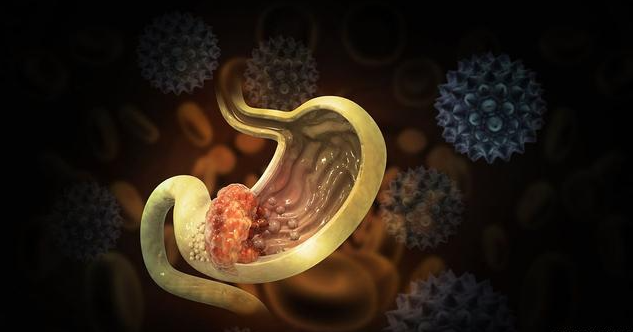 文献解读|Nat Genet（30.8）：胃癌的多祖先基因组和转录组分析