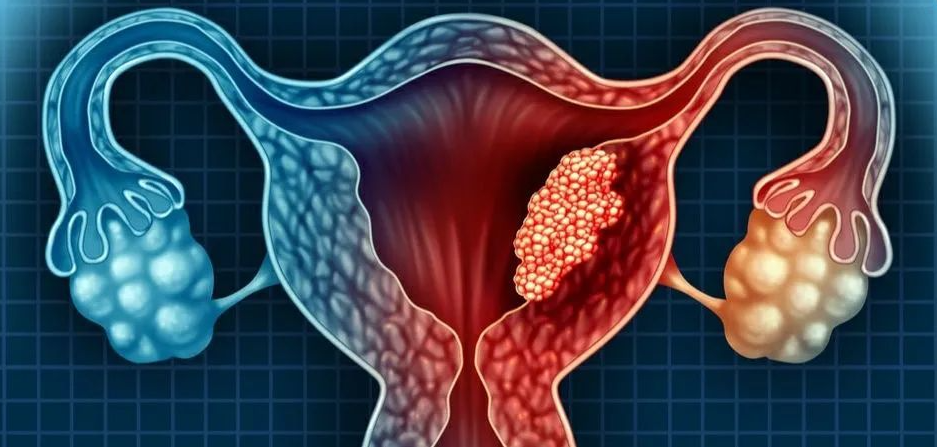 文献解读|Cancer Cell（50.3）：蛋白质组学分析表明子宫内膜癌的药物