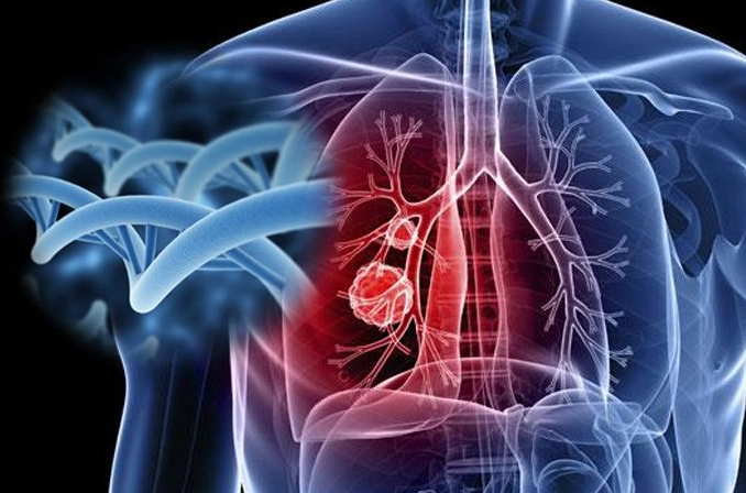 文献解读|Cell Rep Med（14.3）：人肺腺癌发展的免疫细胞图谱揭示了