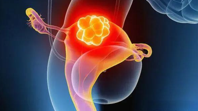 文献解读|Nat Genet（30.8）：早发性子宫内膜样子宫内膜癌的蛋白质组学