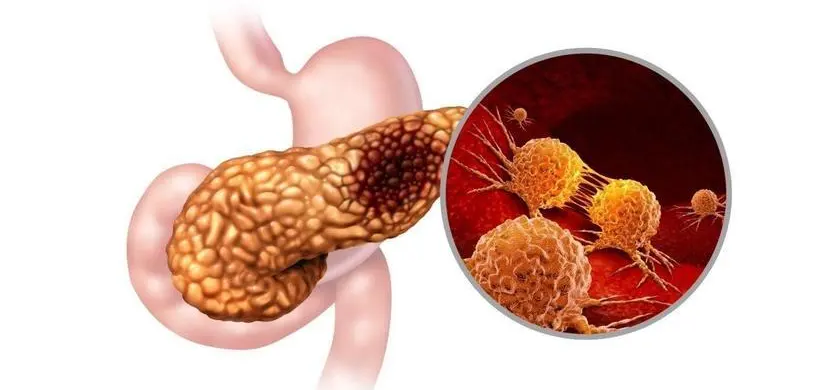 文献解读|Cancer Cell（50.3）：肿瘤细胞内在的表观遗传失调塑造了癌