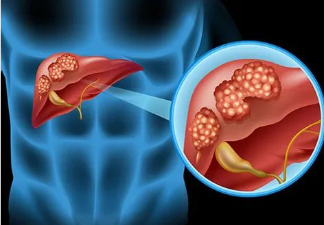 文献解读|J Hepatol（25.7）：肝细胞癌的多模态图谱揭示了趋同进化路径