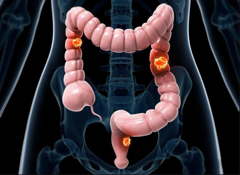 文献解读|Nat Commun（16.6）：纵向血浆蛋白质组分析揭示了结直肠癌诊