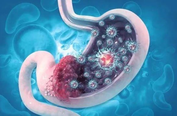 文献解读|Nat Commun（16.6）：用于胃癌诊断和预后的代谢组学机器学习