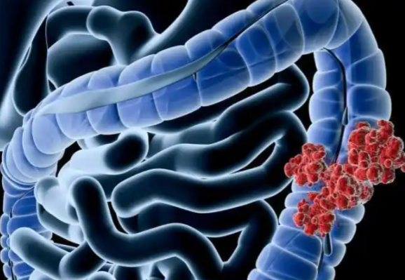 文献解读|Nature（50.5）：结直肠癌的预后基因组和转录组特征