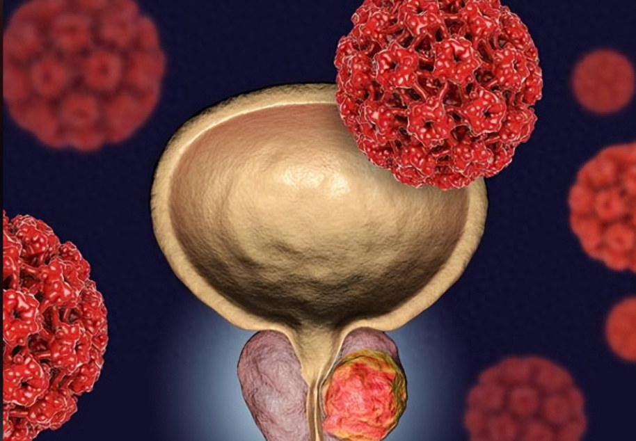 文献解读|Cell Rep Med（11.7）：原发性前列腺癌的蛋白质组图谱分析