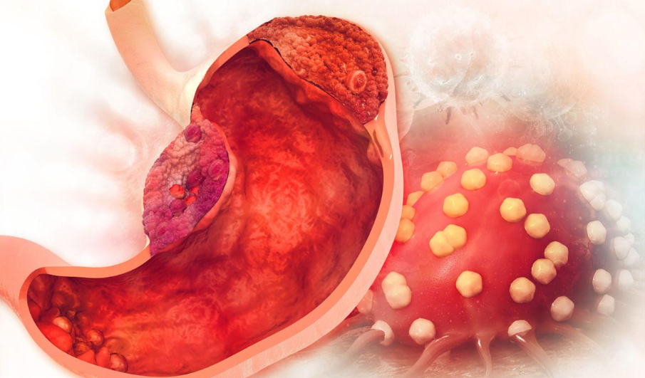 文献解读|Cell Discov（13.0）：肿瘤内微生物群景观特征表明，咽峡炎