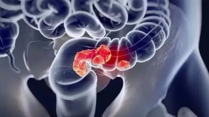 文献解读|Adv Sci（14.3）：通过全面的糖蛋白质组学分析揭示结直肠癌中 