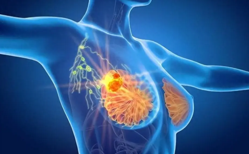 文献解读|Nat Commun（14.7）：空间转录组学揭示三阴性乳腺癌中存在显