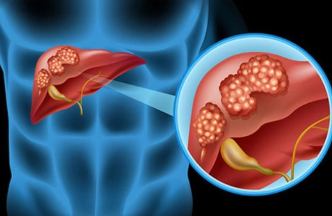 文献解读|J Hepatol（33）：多组学分析揭示肝母细胞瘤的连续分化谱和 W