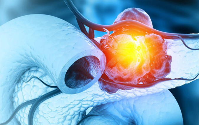 文献解读|Cell Stem Cell（20.4）：胰腺癌类器官生物库通过多组学