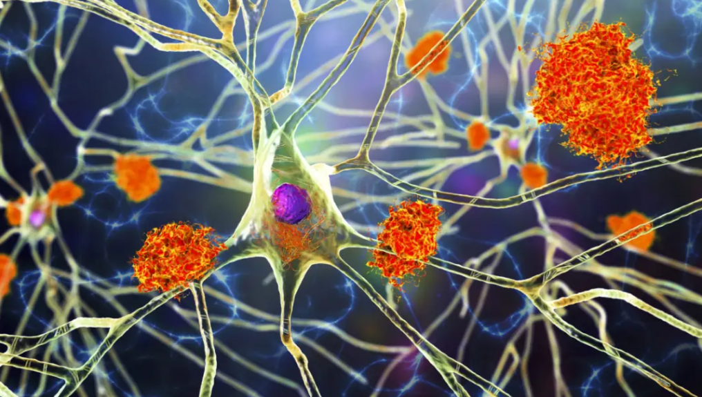 文献解读|Nat Med（50）：小胶质细胞机制驱动免疫阿尔茨海默病患者的淀粉样