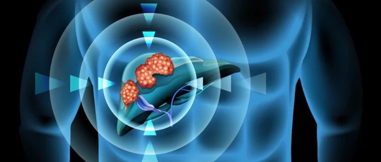 文献解读|Cells（6.600）：分化相关基因建立预后模型用于评估肝细胞癌患者