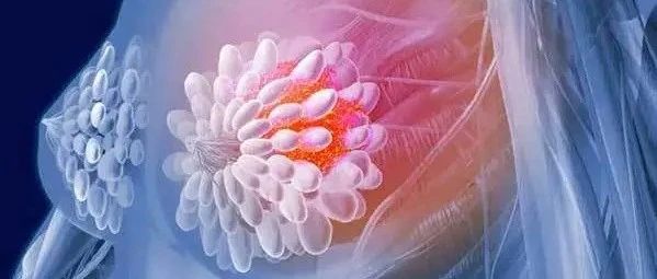 文献解读|Cell Res(46.297): 综合代谢组学拓宽三阴性乳腺癌的精准